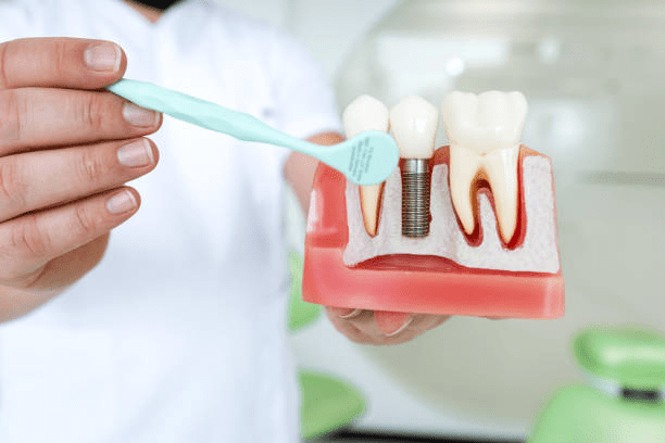 an image of a model tooth with implant