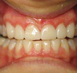 smile1_after