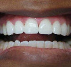 smile2_after