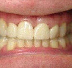 smile3_after