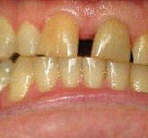 smile3_before