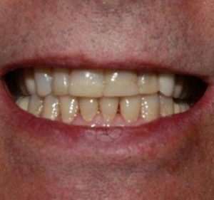 smile7_before