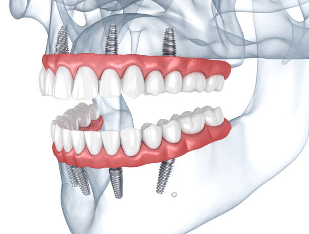 a graphic illustration of a what a dental implant looks like