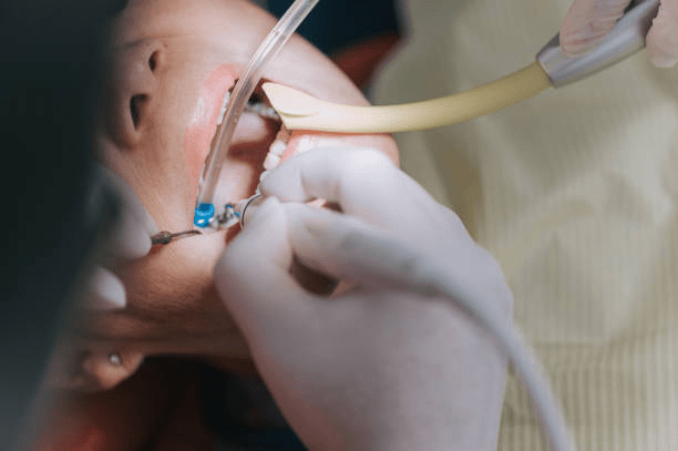 image of a person's mouth during a dental treatment
