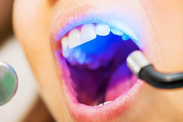 a dentist curing the dental filling in a patient's tooth