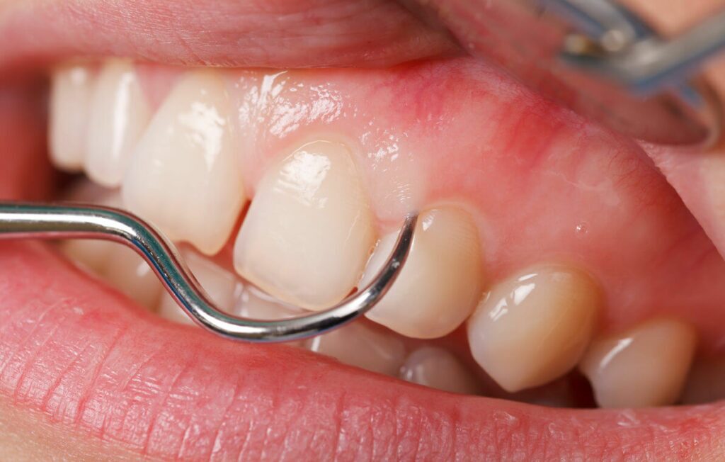 an image of a tooth being cleaned