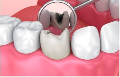 composite fillings