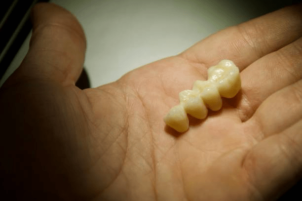 a dental bridge on a person's hand