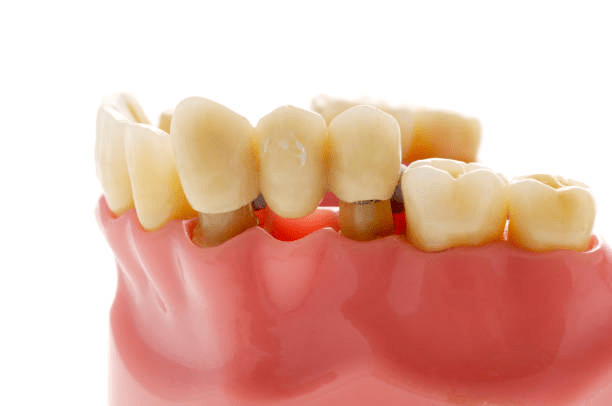 a dental model showing what dental bridges look like